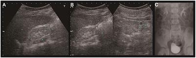 PAX2 Mutation-Related Renal Hypodysplasia: Review of the Literature and Three Case Reports